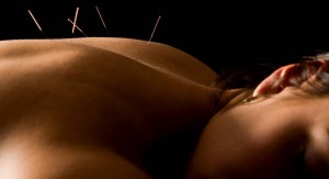 acupuncture